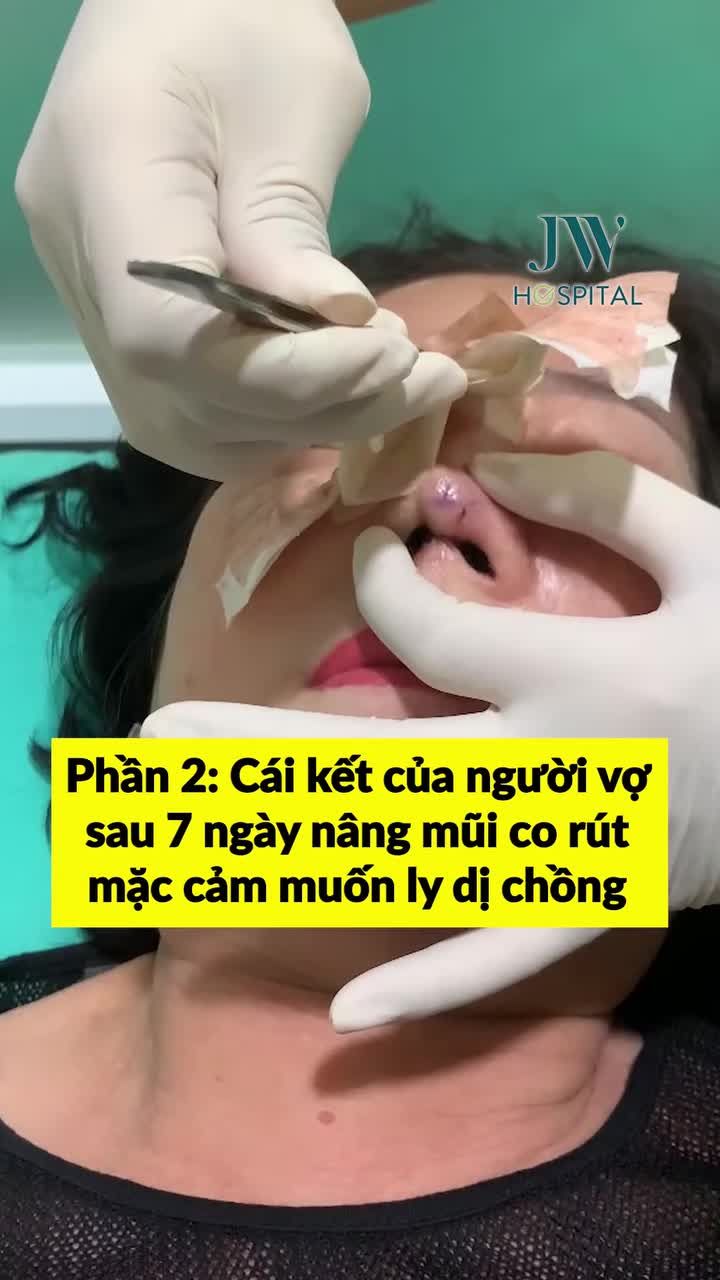 PHẦN 2: CÁI KẾT CỦA NGƯỜI VỢ SAU 7 NGÀY NÂNG MŨI CO RÚT MẶC CẢM MUỐN LY DỊ CHỒNG