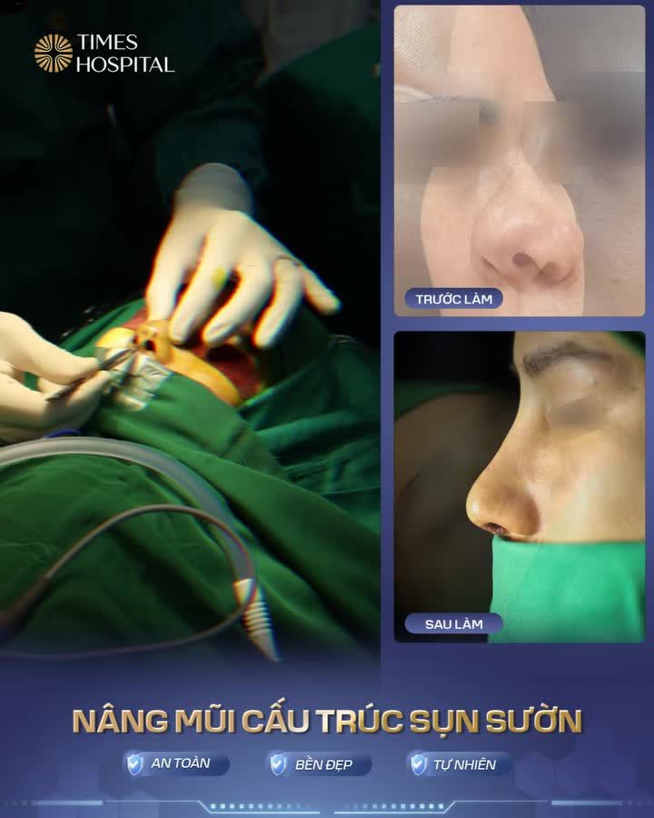 NÂNG MŨI SỤN SƯỜN - LỰA CHỌN TỐI ƯU ĐỂ NÂNG CẤP DÁNG MŨI