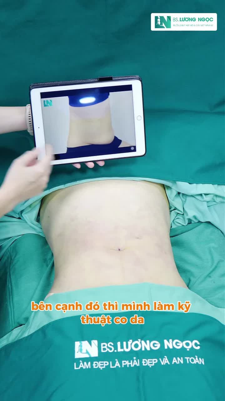 Cùng Ekip Bác sĩ Lương Ngọc theo dõi kết quả sau hút mỡ tạo dáng mới toanh sáng nay