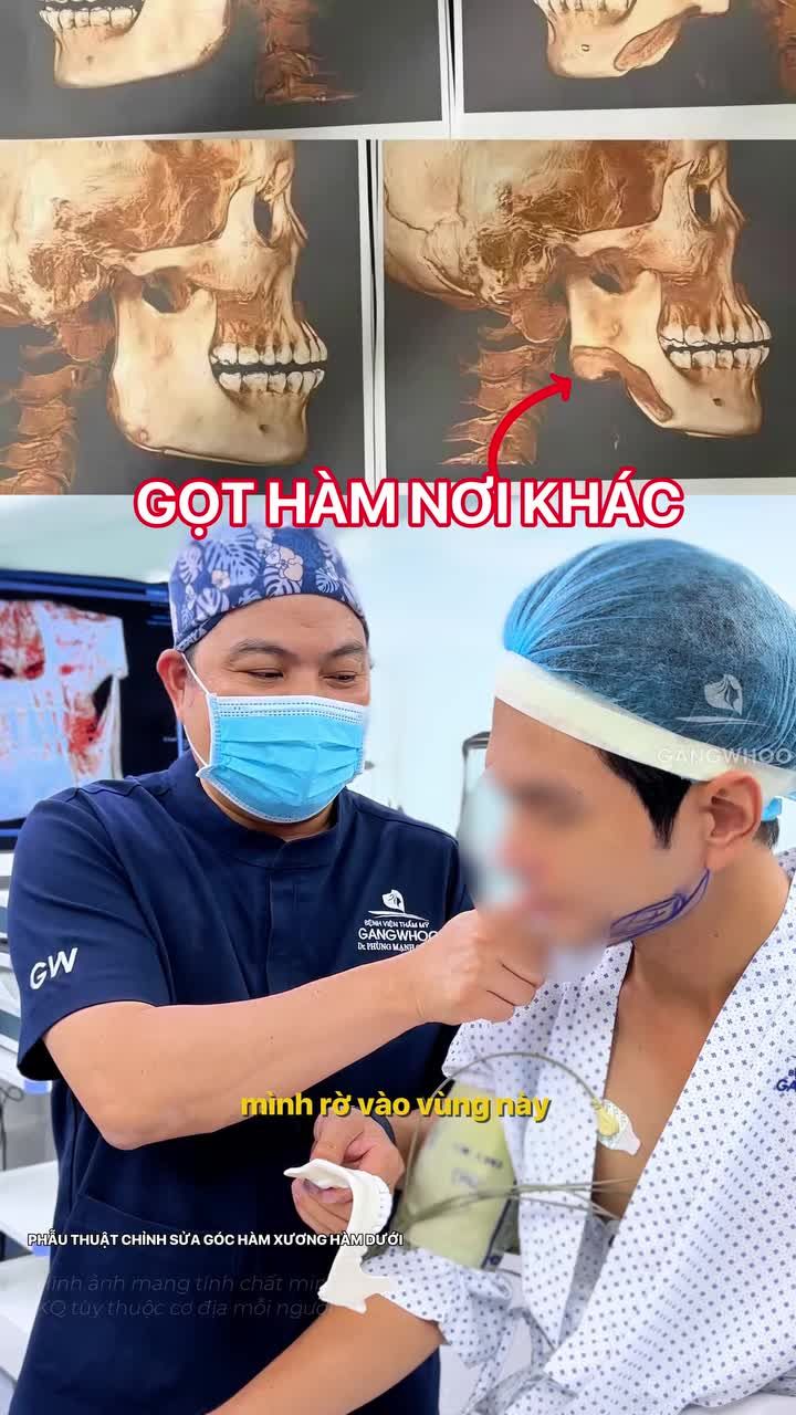 Một điểm khác biệt của gọt hàm có sử dụng nội soi 4K tại Bệnh viện thẩm mỹ Gangwhoo