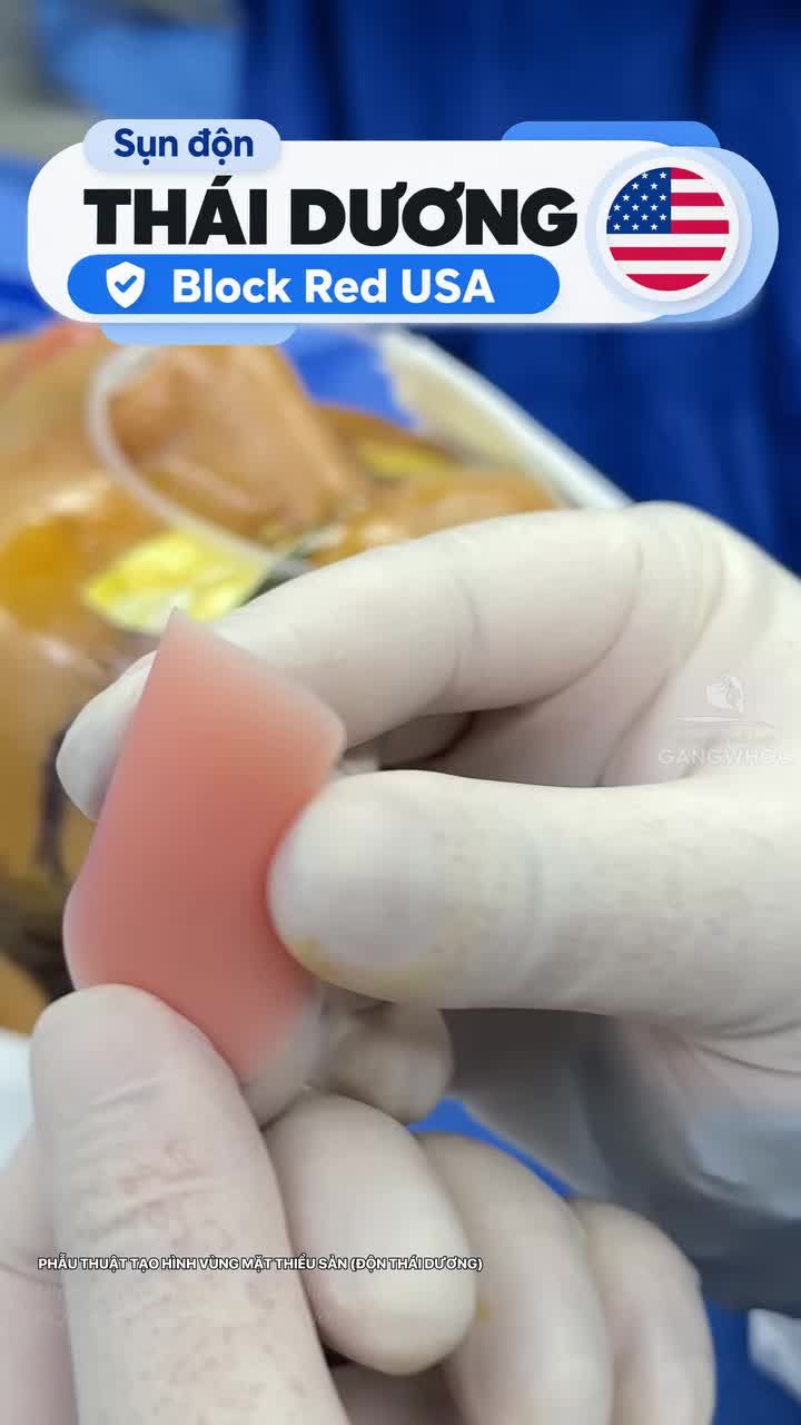 Loại sụn nào được bác sĩ ưa chuộng trong phẫu thuật độn thái dương?