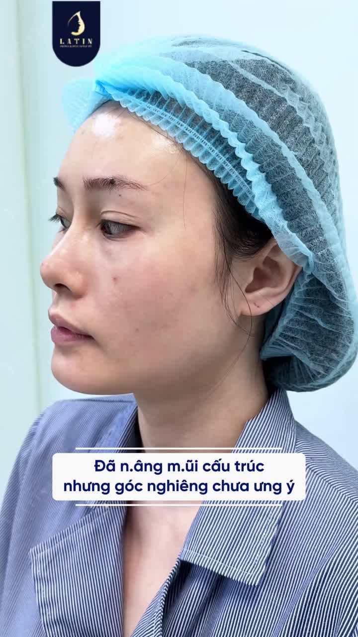 “LÀM LẠI TỪ ĐẦU” DÁNG MŨI VỚI “THANH NGỌC” SURGIFORM