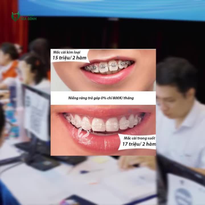 TÂN SINH VIÊN MỚI LÊN HÀ NỘI: ĐỪNG VỘI NIỀNG RĂNG CHỈ VÌ… GIÁ RẺ!