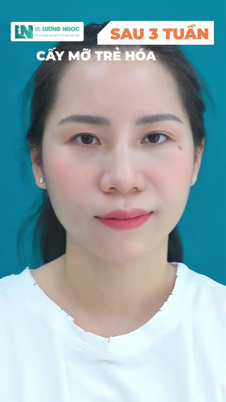 CẤY MỠ TỰ THÂN – TÁI PHÂN BỔ THỂ TÍCH, TÔN TẠO ĐƯỜNG NÉT