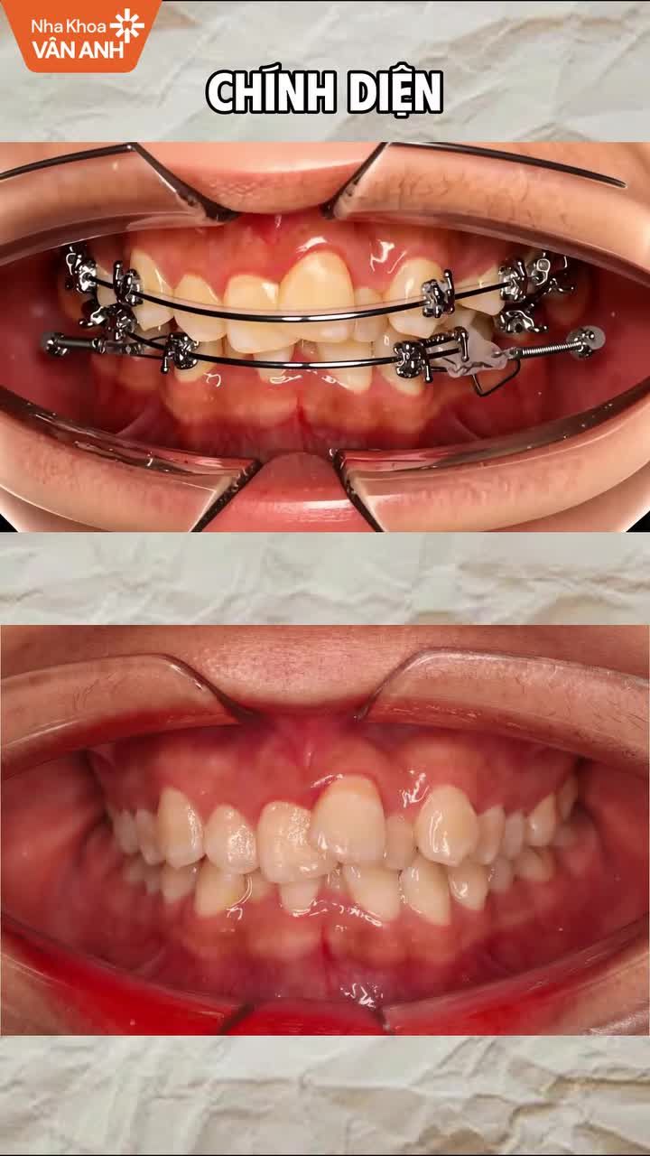 Tình trạng: Răng khấp khểnh hai hàm, sai khớp cắn, cần nhổ 4 răng để tạo khoảng, kéo lùi và chỉnh tương quan hai hàm.