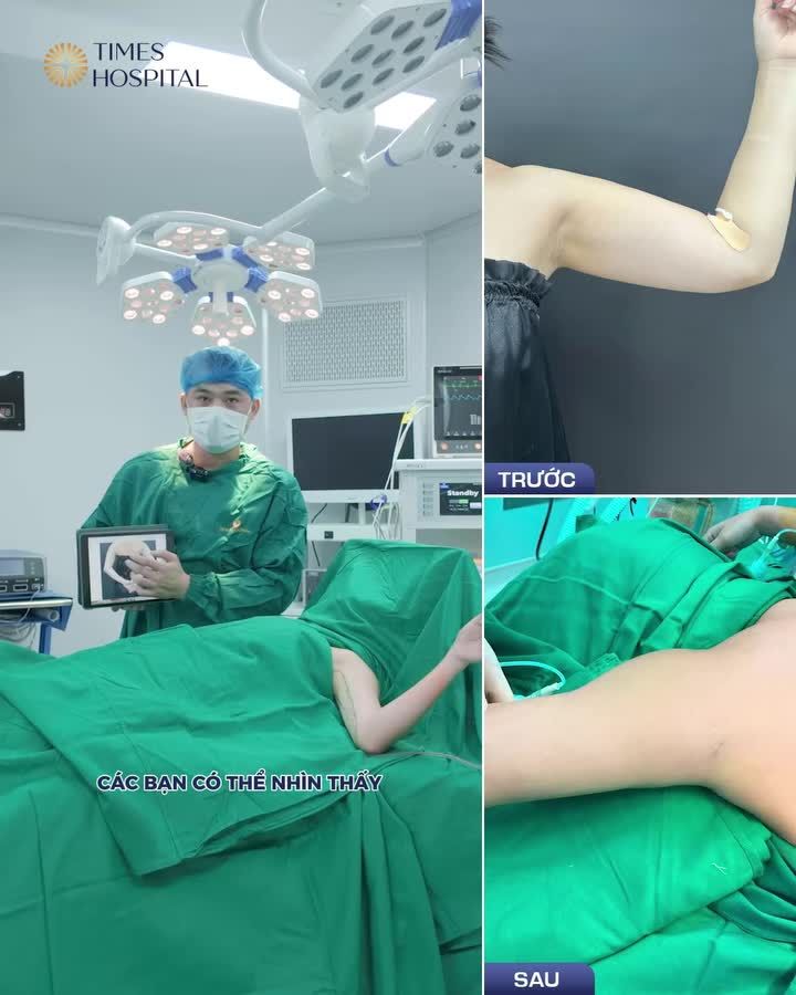 TẠM BIỆT BẮP TAY KÉM THON CHỈ SAU 30 PHÚT