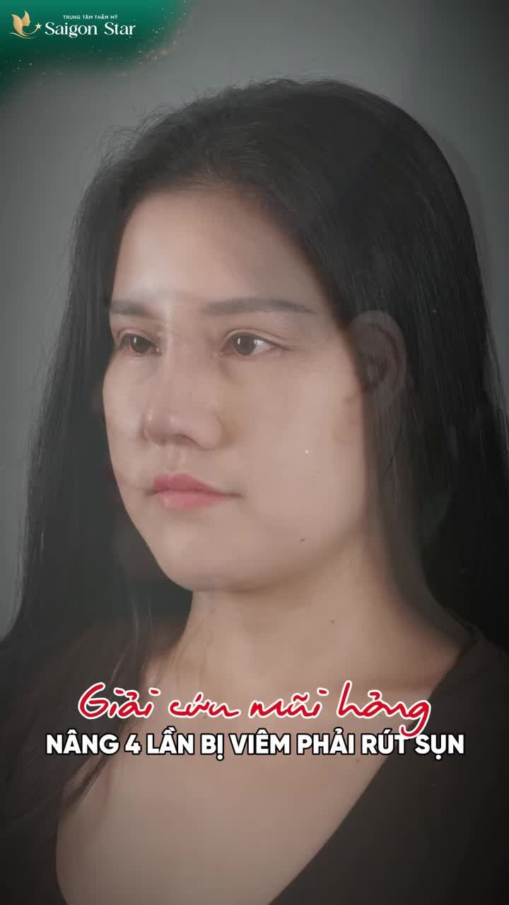 4 LẦN NÂNG MŨI THẤT BẠI LẦN THỨ 5 MŨI ĐẸP NHƯ Ý