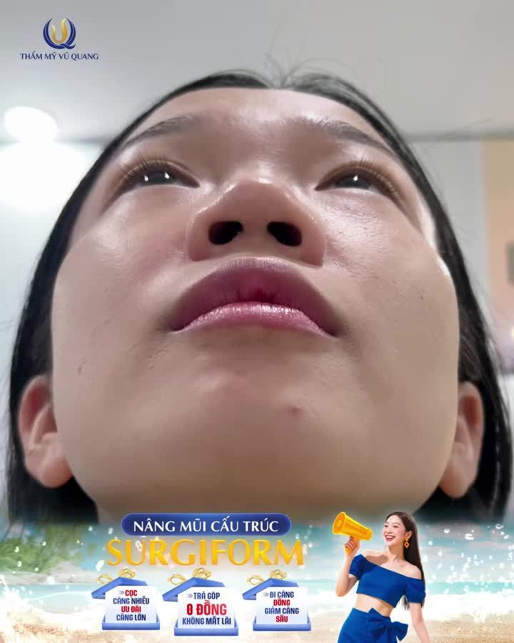 Chìa khóa cho chiếc mũi thanh tú, chuẩn tỷ lệ vàng của hot girl Hạnh Đậu Đậu chính là công nghệ Nâng mũi cấu trúc Surgiform – an toàn, bền đẹp và tự nhiên như thật.