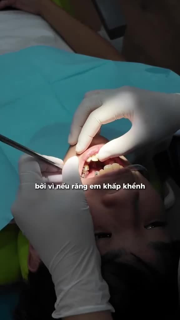 Làm răng sứ rồi niềng răng được không?