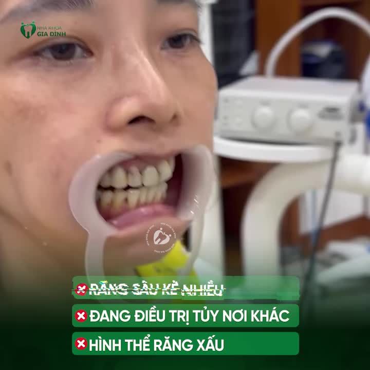 THẨM MỸ RĂNG SỨ GIẢI PHÁP KHẮC PHỤC TÌNH TRẠNG RĂNG SÂU KẼ