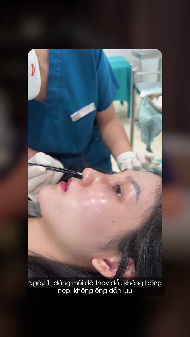 7 ngày nâng mũi không nẹp của khách hàng thực tế sẽ như thế nào?