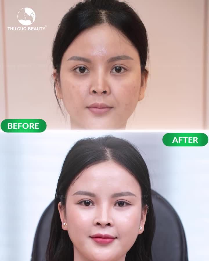 DA CĂNG BÓNG – MƯỚT MỊN, SÁNG ĐỀU MÀU CÙNG MESO HYDRATE+ PRO