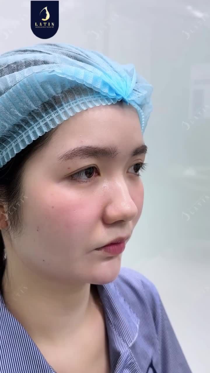 NẮN LẠI NẾP MÍ LỆCH NÉT- ĐƯA ÁNH NHÌN VỀ ĐÚNG ĐIỆU