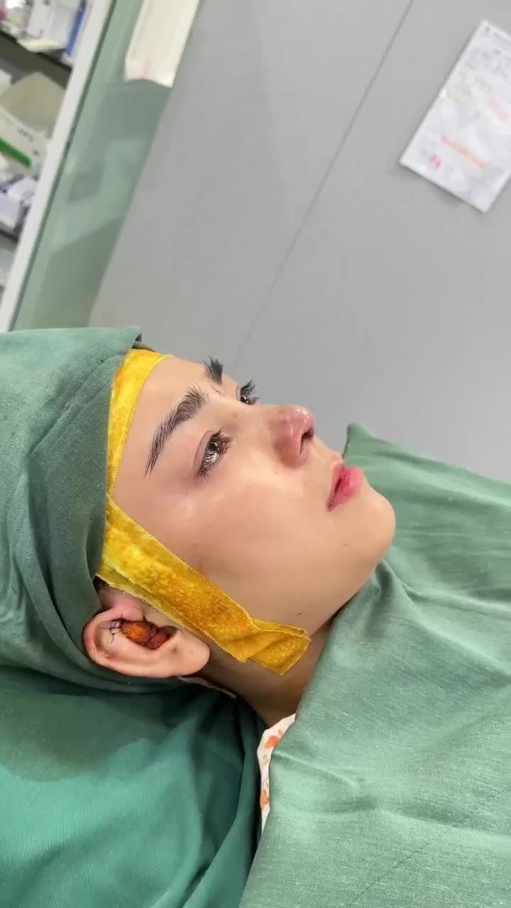 KẾT QUẢ NÂNG MŨI CẤU TRÚC SỬA LẠI | KH. THU PHƯỢNG