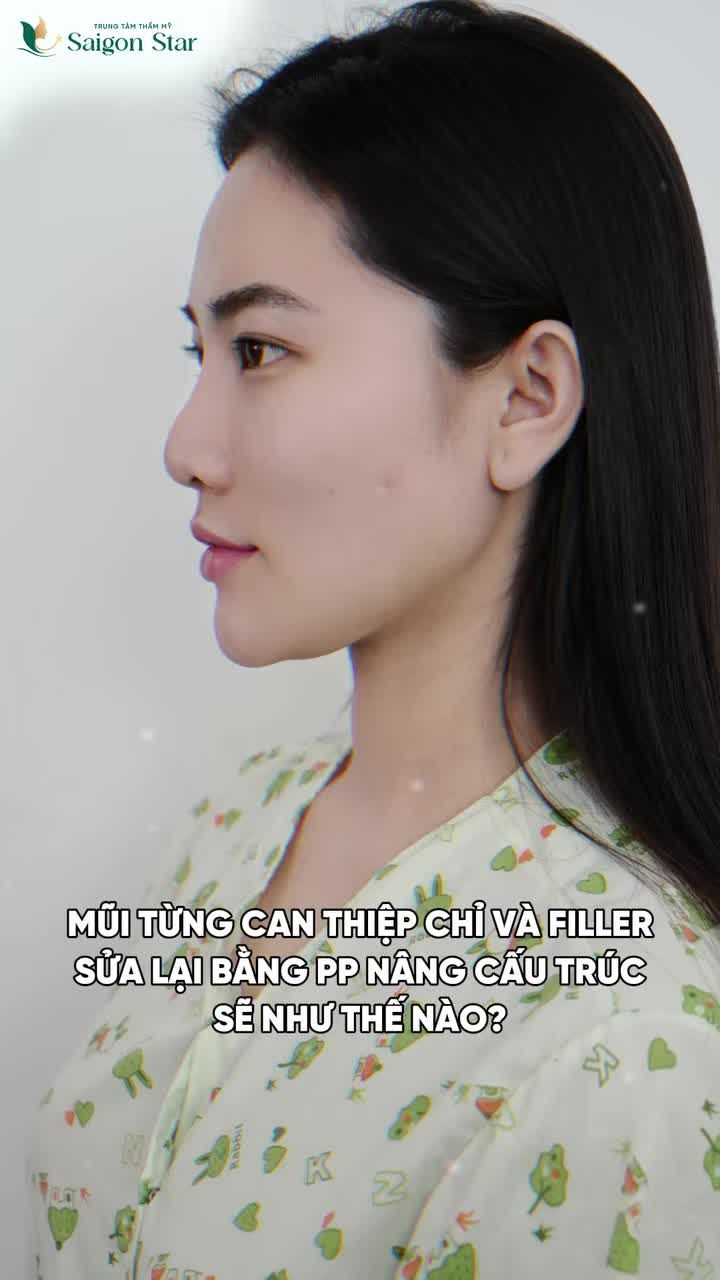 KẾT QUẢ NÂNG MŨI CẤU TRÚC DR.HOẠT - KHẮC PHỤC BIẾN CHỨNG DO NÂNG MŨI BẰNG CHỈ VÀ TIÊM FILLER