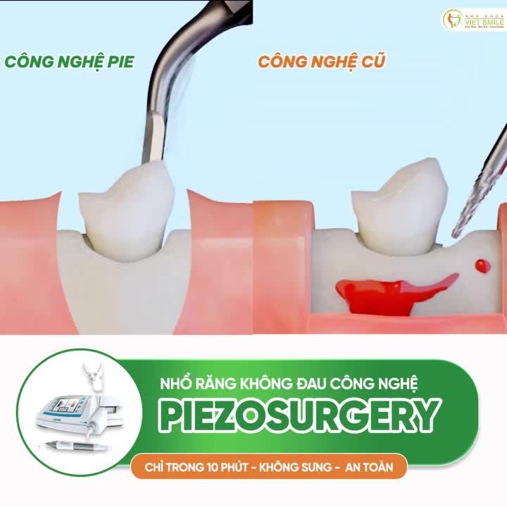 Đừng để chiếc răng khôn "hành" bạn cả tuần chỉ vì chọn nhổ theo cách cũ!