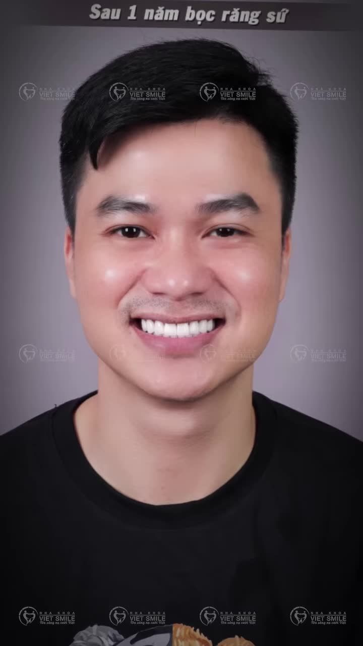 Thay đổi nụ cười sau bọc 16 răng sứ Nacera đa lớp