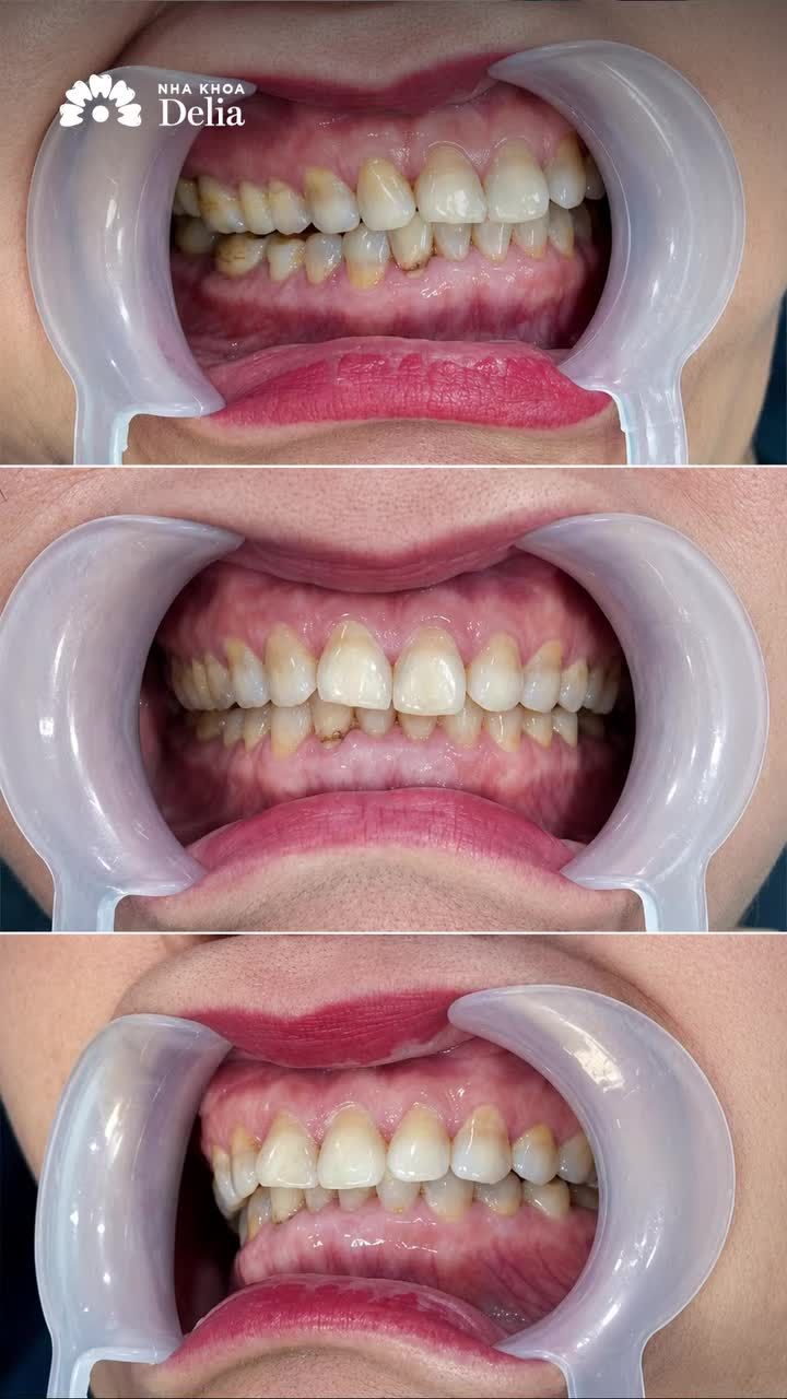RĂNG NHIỄM TETRACYCLINE  NỖI BẬN TÂM CHUNG CỦA U50? Xem ngay!