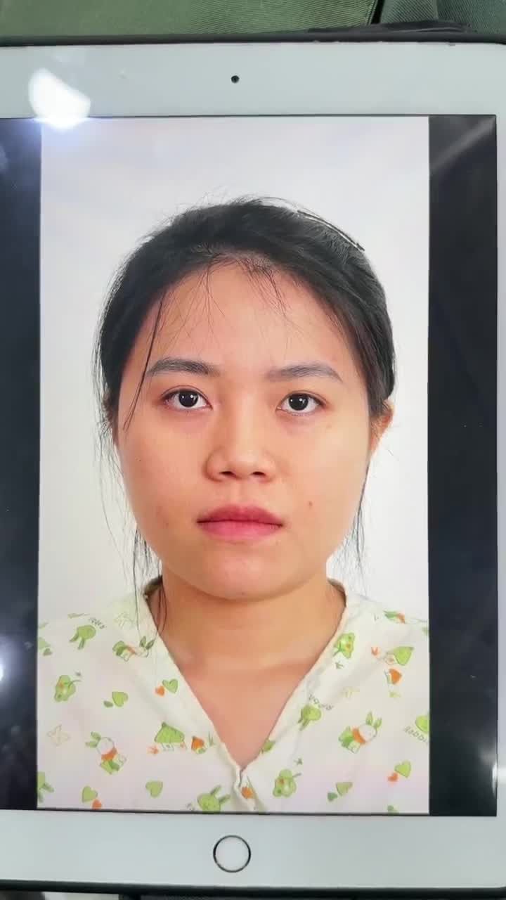 TRẢ KẾT QUẢ NÂNG MŨI NGAY SAU PHẪU THUẬT