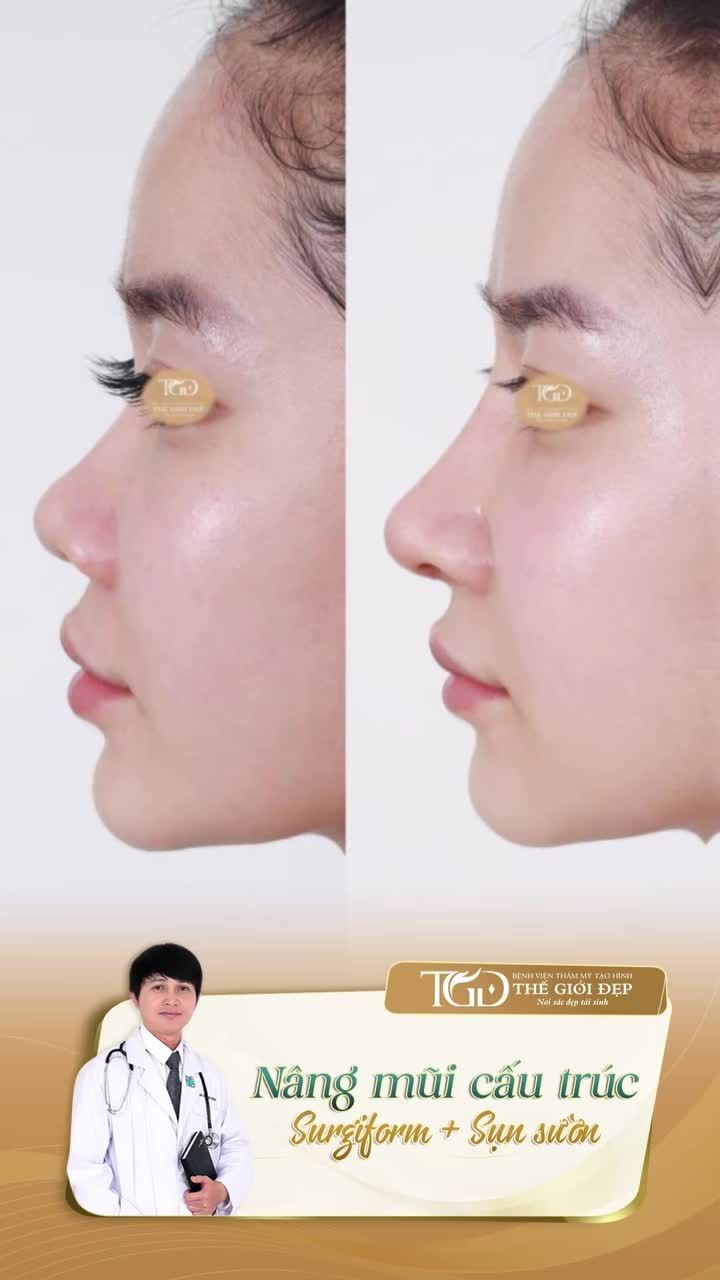Góc nghiêng thay đổi – Dáng mũi hài hòa hơn với nâng mũi cấu trúc Surgiform sụn tự thân