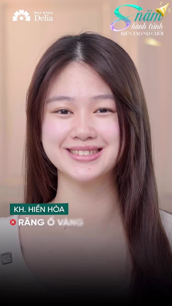 Dáng Răng Thỏ - "Vũ Khí" giúp khách hàng thay đổi ngoạn mục tại Delia!