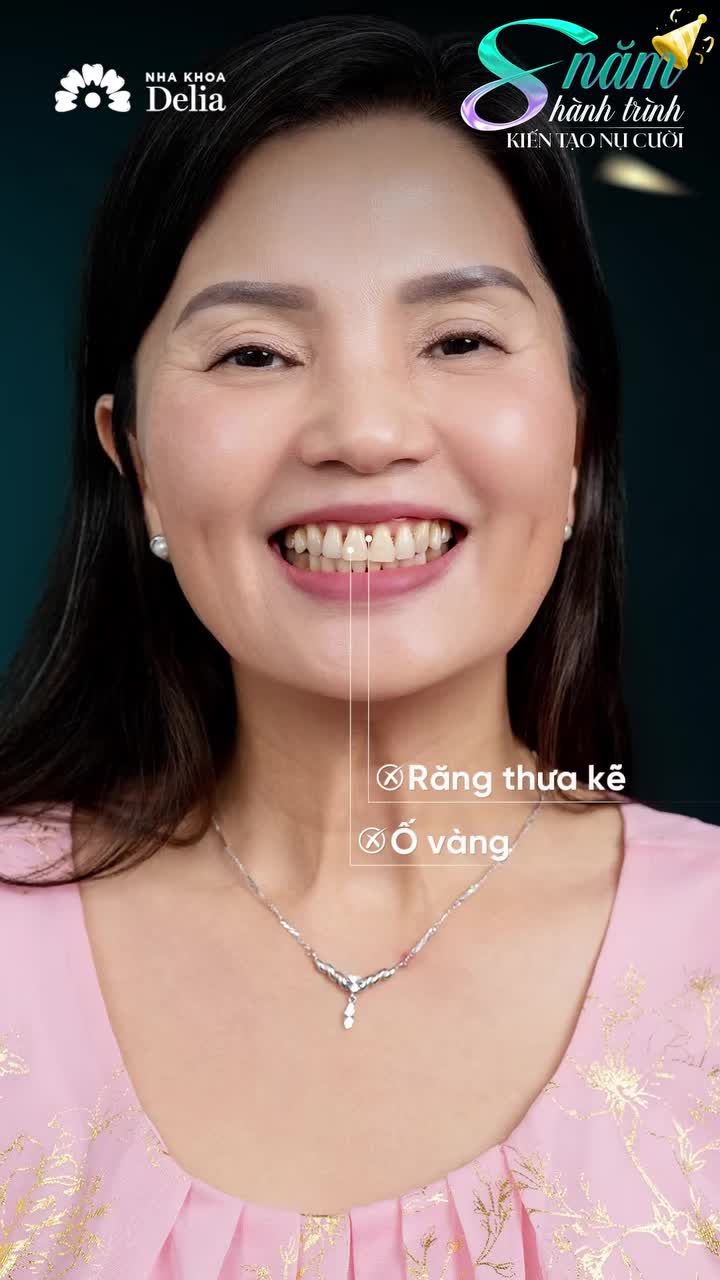 "Nếu cho lựa chọn lại lần nữa, chị vẫn sẽ chọn Delia để làm răng sứ."