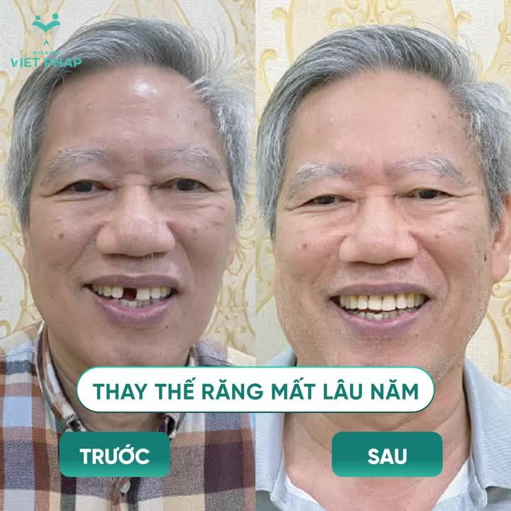 MẤT RĂNG LÂU NĂM CÓ TRỒNG IMPLANT ĐƯỢC KHÔNG?