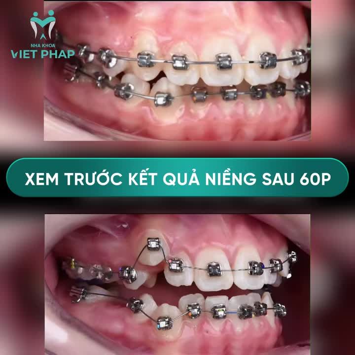 HÀM RĂNG SẼ DỊCH CHUYỂN NHƯ THẾ NÀO KHI NIỀNG?