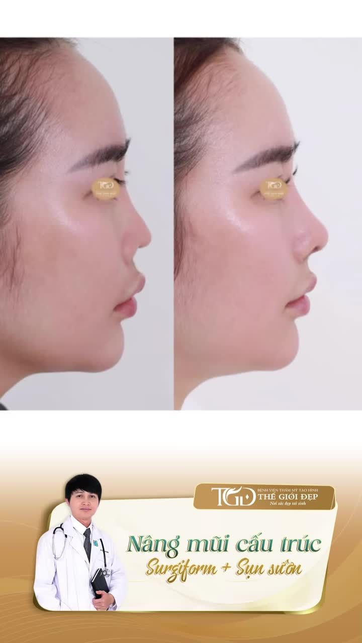 Tái sinh dung nhan từ nền mũi phức tạp sau 3 lần phẫu thuật