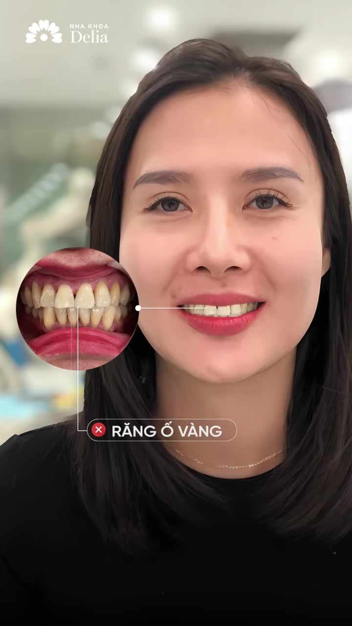 Giáo viên ở TP. Quảng Ninh: Làm răng sứ tôi chỉ tin chọn lên Delia Hà Nội