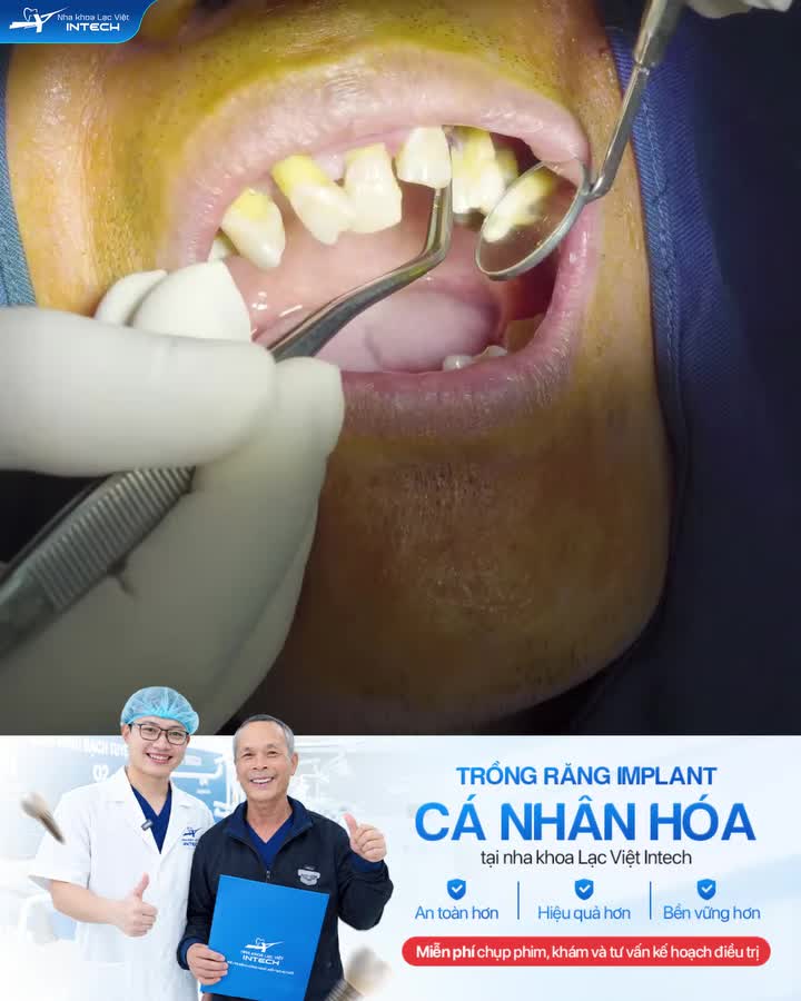 CẬN CẢNH QUÁ TRÌNH CẤY GHÉP IMPLANT CHO KHÁCH HÀNG MẤT RĂNG LÂU NĂM, TIÊU XƯƠNG