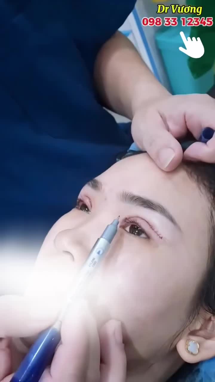 Nhẹ nhàng cắt mí với Dr Vương