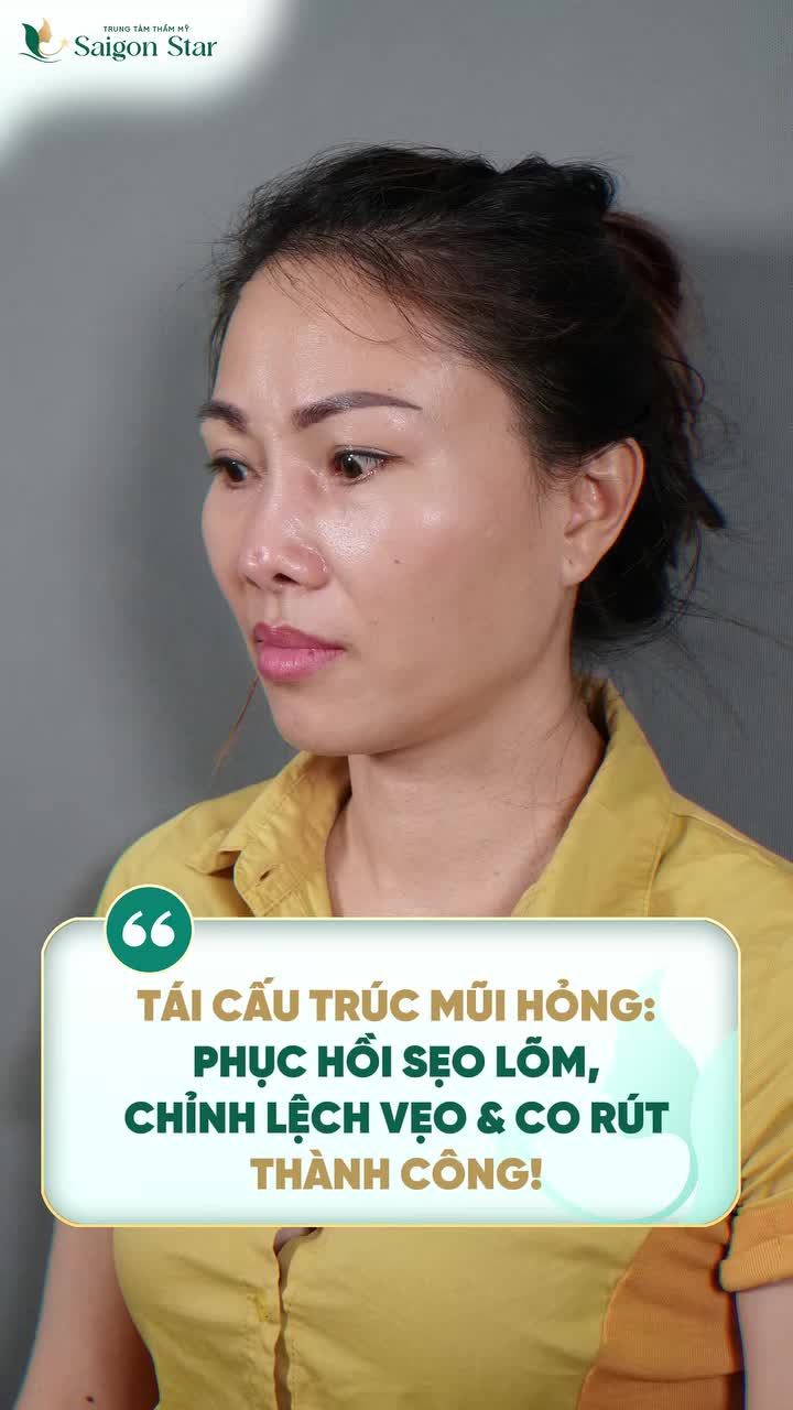 TÁI CẤU TRÚC MŨI HỎNG THÀNH CÔNG PHỤC HỒI MŨI LỆCH, CO RÚT, SẸO LÕM CHỈ TRONG 60 PHÚT