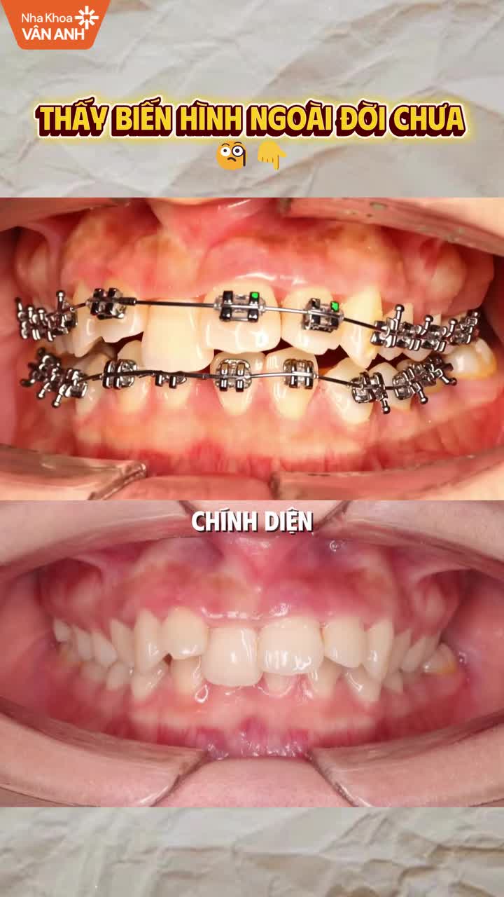 Răng khấp khểnh hai hàm, sai khớp cắn, cần tạo khoảng để sắp đều răng, kéo lùi nhóm răng phía trước và điều chỉnh tương quan hai hàm.