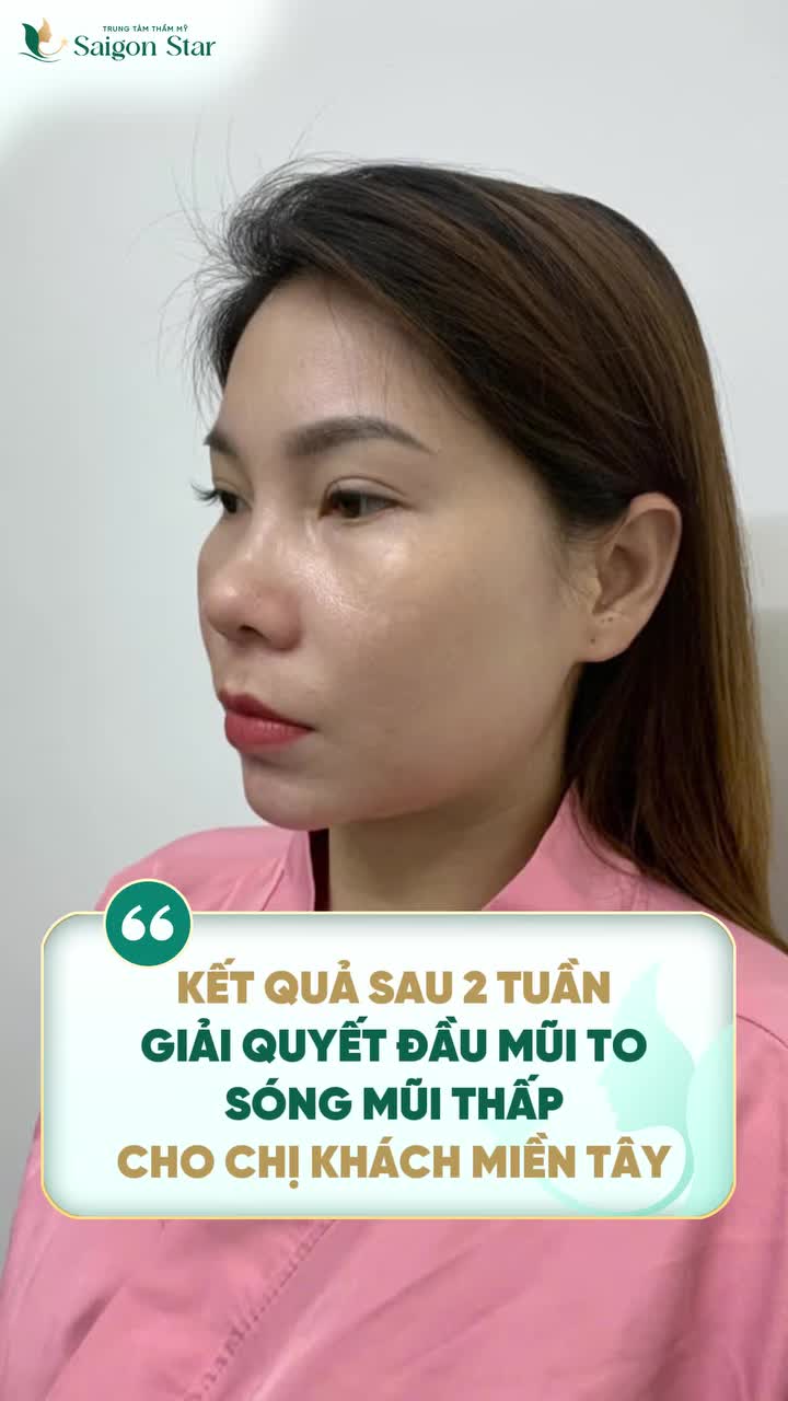 Mũi cao thanh thoát  - Ngũ quan hài hòa  - Hồi phục nhanh – không sưng không bầm