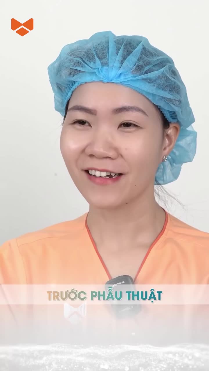 Lại thêm 1 ca Nâng mũi không băng nẹp Mega S, không bao giờ làm chúng ta thất vọng