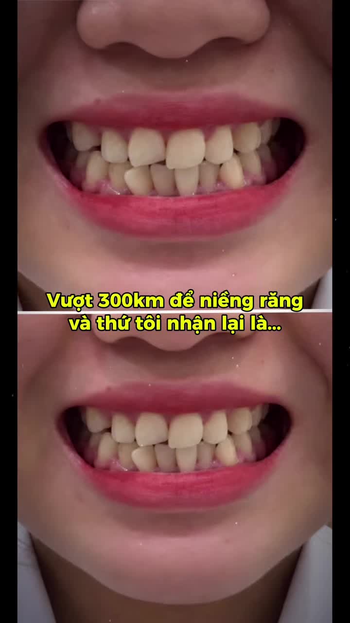 Đi 300km để nhận lại hàm răng đều đẹp và nụ cười tự tin