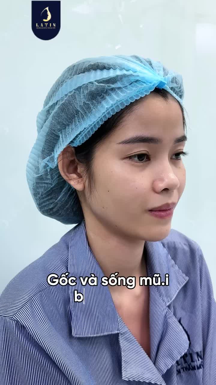 "TẠM BIỆT" FILLER - F5 DIỆN MẠO VỚI MŨI CẤU TRÚC SAU 10 NGÀY