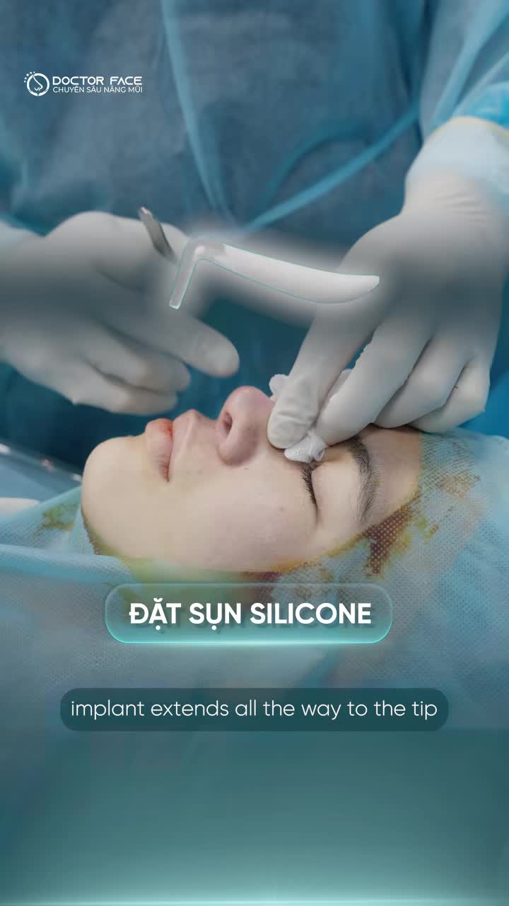 Đầu mũi cong bất thường sau nâng, nhìn giống viêm hoặc lộ sụn nhưng liệu có đúng như vậy?