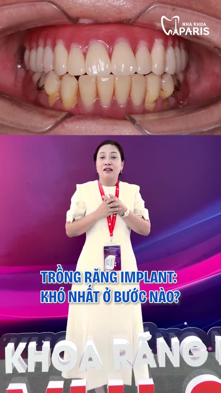 TRỒNG RĂNG IMPLANT – KHÓ NHẤT Ở BƯỚC NÀO?