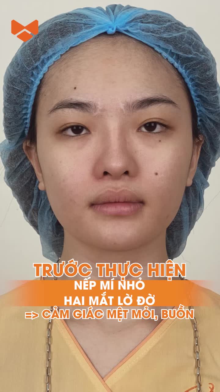 Lấy lại sự tự tin với cặp mắt to rõ hơn
