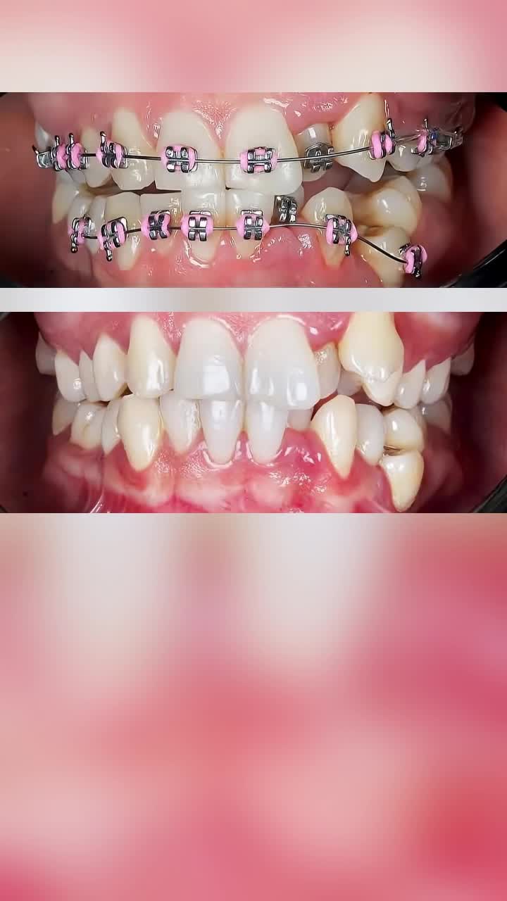 Khấp khểnh gặp mắc cài cũng chỉ 2 năm thôi