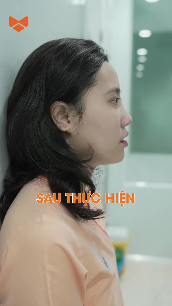 Nâng mũi không băng nẹp, chỉ 1 tiếng là đẹp