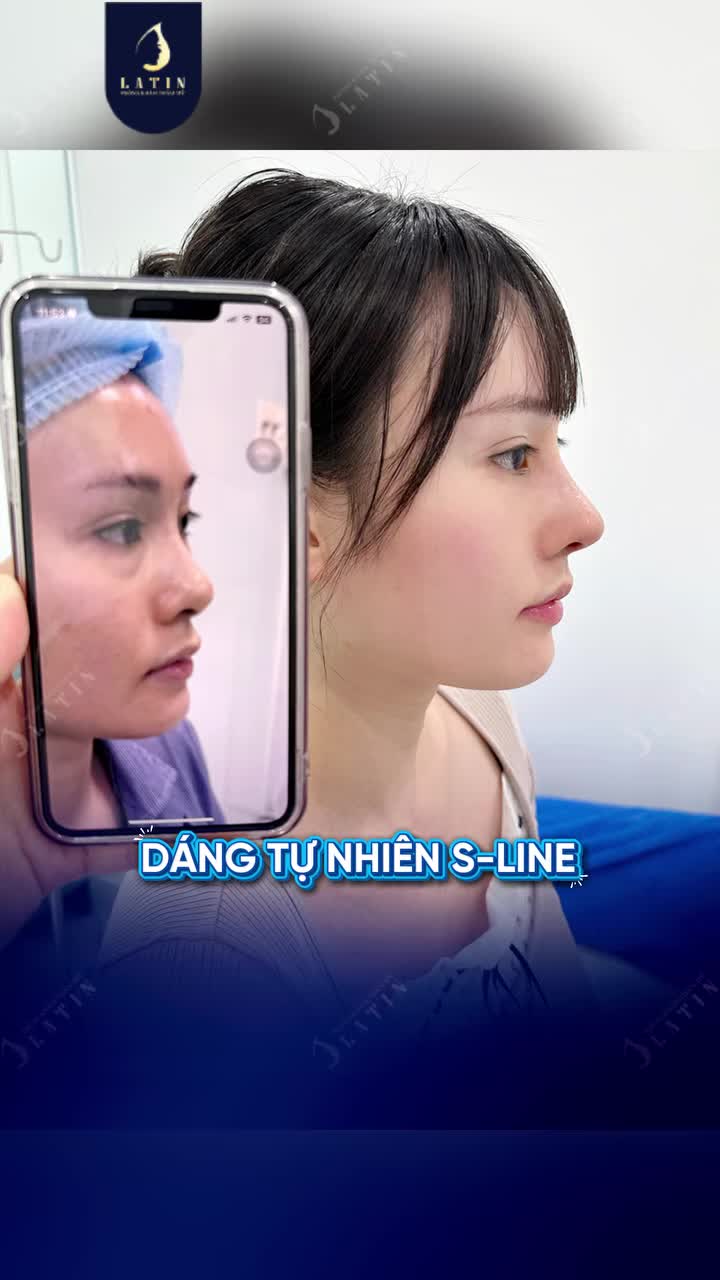 MŨI BAY TRUNG HOA VS M.Ũ.I TỰ NHIÊN ĐÂU LÀ DÁNG MŨI CHÂN ÁI KHI SỬA LẠI?