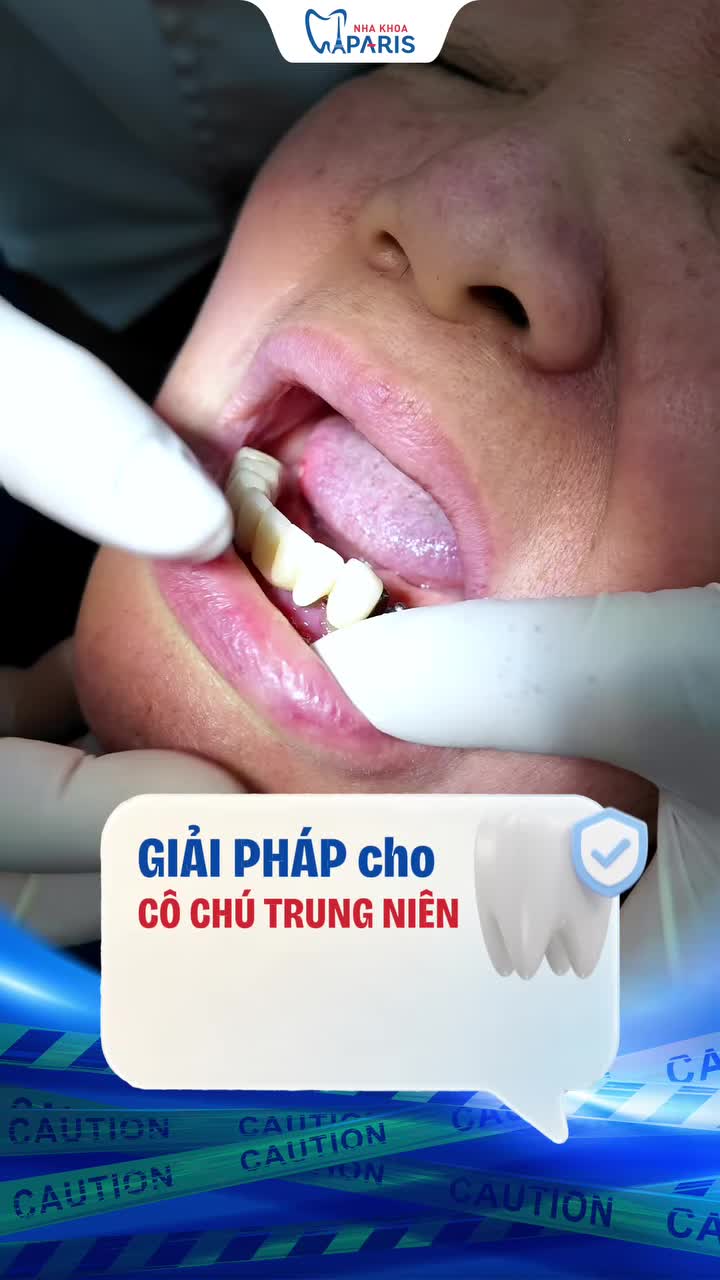 LÀM CẦU RĂNG SỨ 1 NĂM ĐÃ HỎNG, ĐAU NHỨC KHÔNG ĂN NHAI NỔI?