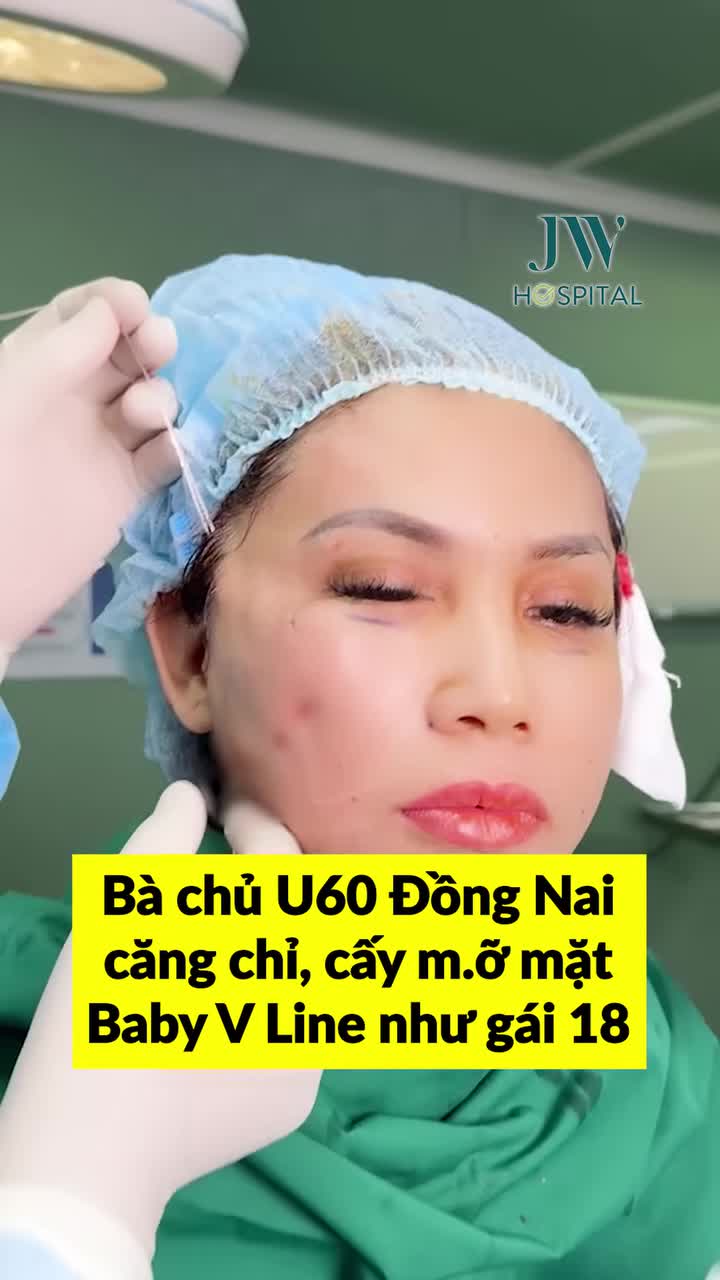 U60 ĐỒNG NAI BÁN HẾT ĐỒN ĐIỀN CAO SU, BẮT XE VÀO SÀI GÒN CĂNG CHỈ MESH LIFT, CẤY Μ.Ỡ BABY FACE TRẺ 20 TUỔI, SẸΟ VÔ HÌNH