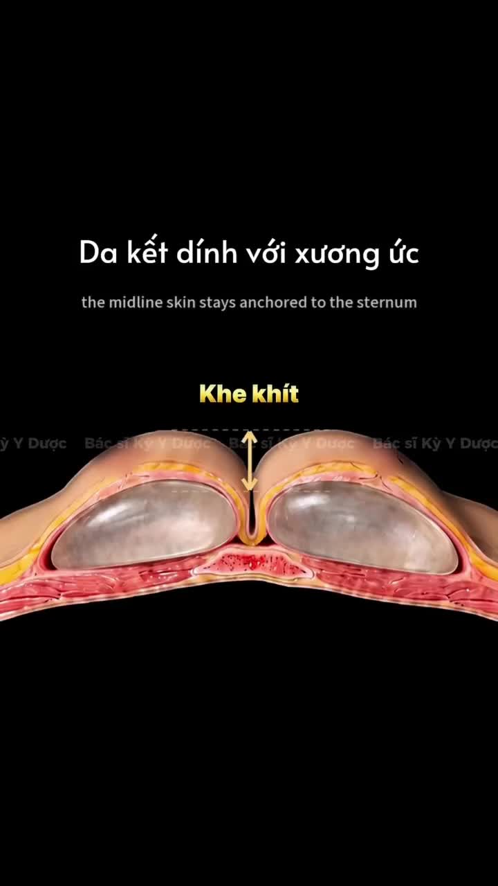 Hiểu rõ về tình trạng thông khe sau tạo hình V1
