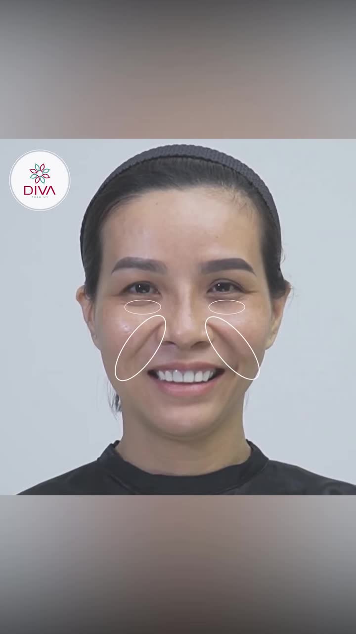 Giảm chảy xệ, giảm tình trạng rãnh cười sâu với 13cc Filler MD Codes