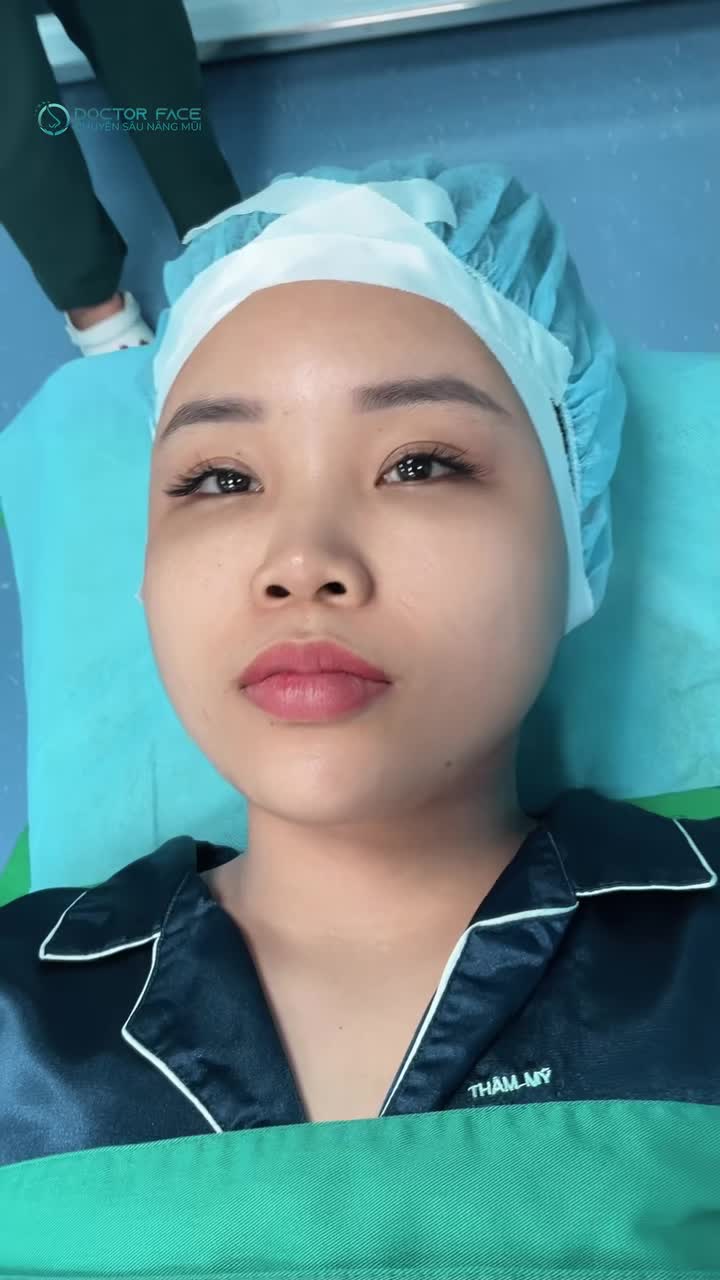 Không cần quá cao để nhìn khác. Tỷ lệ phù hợp, gương mặt tự nhiên đã có điểm nhấn hơn Ngày thứ 5 sau nâng mũi của cô ấy