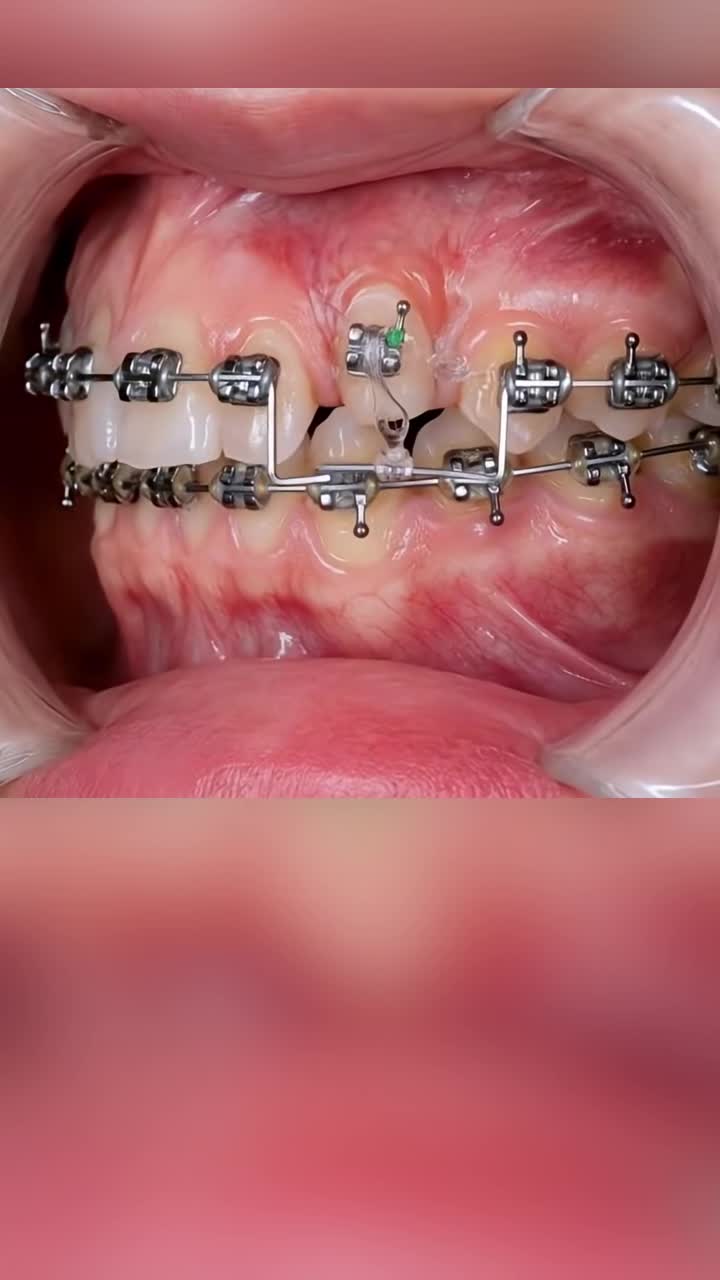 Xem thêm 72 video Niềng Răng của bác sĩ Bs nha khoa Ngân Phượng